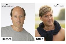 Western Maryland Hair Replacement Center image 1