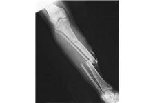OrthoTexas - Knee Pain Frisco image 2