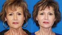 Carmel Valley Facial Plastic Surgery image 2