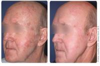 Halo Laser and Aesthetic Medicine image 7