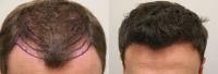 FUE Hairline Clinic image 3