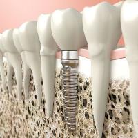 Mesa Dental Implants & Periodontics image 1