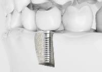 Chandler Dental Implants & Periodontics image 1