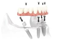 Mesa Dental Implants & Periodontics image 4
