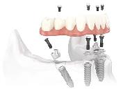 Chandler Dental Implants & Periodontics image 2