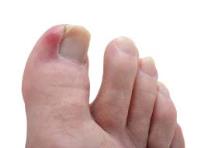 Ingrown Toenail Therapy New Jersey (Morganville) image 2