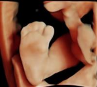 Prenatal Universe Ultrasound image 2