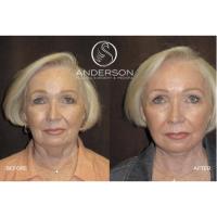 Anderson Plastic Surgery & Med Spa image 4