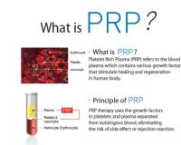 PRP Injection MD image 3