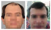 ForHair Hair Transplant Clinic image 35
