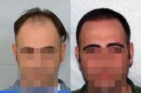 ForHair Hair Transplant Clinic image 38