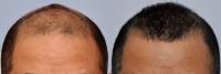 ForHair Hair Transplant Clinic image 34