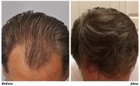 ForHair Hair Transplant Clinic image 2