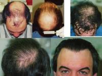 ForHair Hair Transplant Clinic image 13