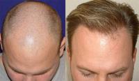 ForHair Hair Transplant Clinic image 37