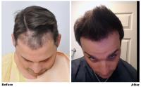 ForHair Hair Transplant Clinic image 9