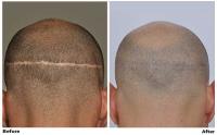 ForHair Hair Transplant Clinic image 1