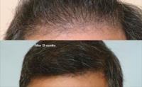ForHair Hair Transplant Clinic image 23