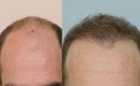 ForHair Hair Transplant Clinic image 21