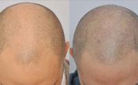 ForHair Hair Transplant Clinic image 25