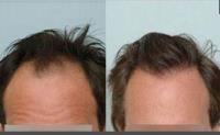 ForHair Hair Transplant Clinic image 17