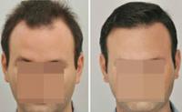 ForHair Hair Transplant Clinic image 27