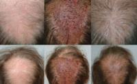 ForHair Hair Transplant Clinic image 22