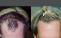 ForHair Hair Transplant Clinic image 14