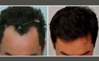 ForHair Hair Transplant Clinic image 26