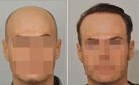 ForHair Hair Transplant Clinic image 28