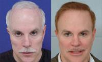 ForHair Hair Transplant Clinic image 24