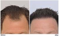 ForHair Hair Transplant Clinic image 4