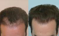 ForHair Hair Transplant Clinic image 15