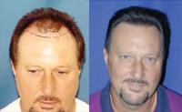 ForHair Hair Transplant Clinic image 16