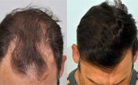 ForHair Hair Transplant Clinic image 30
