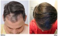 ForHair Hair Transplant Clinic image 5