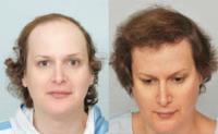 ForHair Hair Transplant Clinic image 19