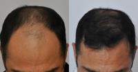 ForHair Hair Transplant Clinic image 39