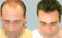 ForHair Hair Transplant Clinic image 31