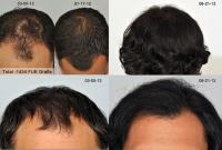 ForHair Hair Transplant Clinic image 48