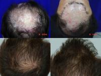 ForHair Hair Transplant Clinic image 45