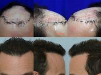 ForHair Hair Transplant Clinic image 46