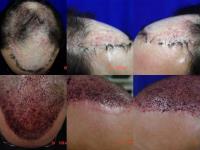 ForHair Hair Transplant Clinic image 43