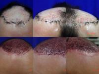 ForHair Hair Transplant Clinic image 44
