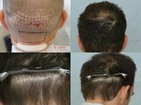 ForHair Hair Transplant Clinic image 42