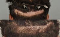 ForHair Hair Transplant Clinic image 49