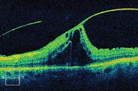 High Country Macula, Retina, and Vitreous, PC image 5