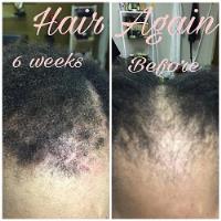 Hair Again Certified Hair Loss Specialists image 1