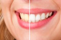 Carte Blanche Teeth Whitening Los Angeles image 4