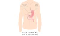Gastric Sleeve Surgery image 3